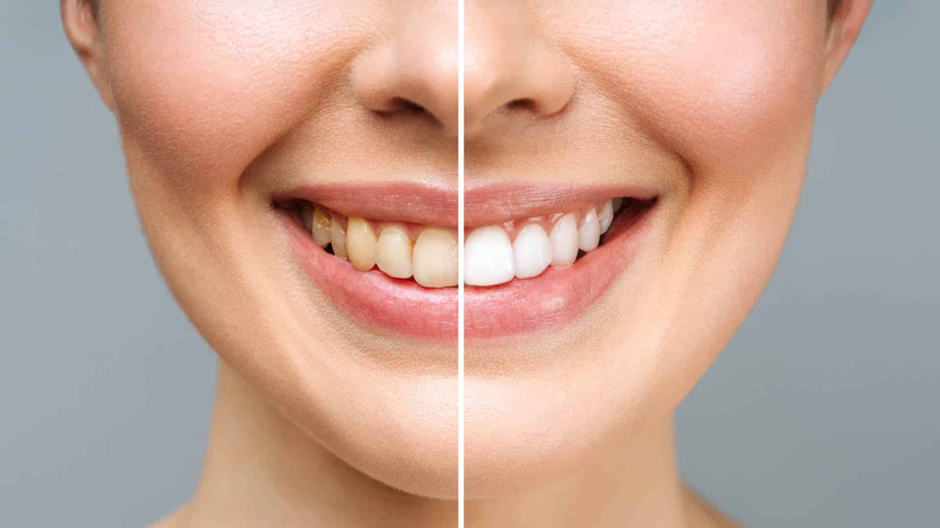 Perfect white smail against old yellow teeth before and after