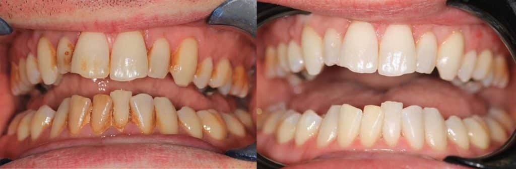 before and after gbt treatment 