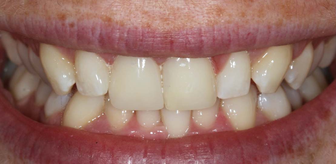 bonded teeth results with composite resin material after