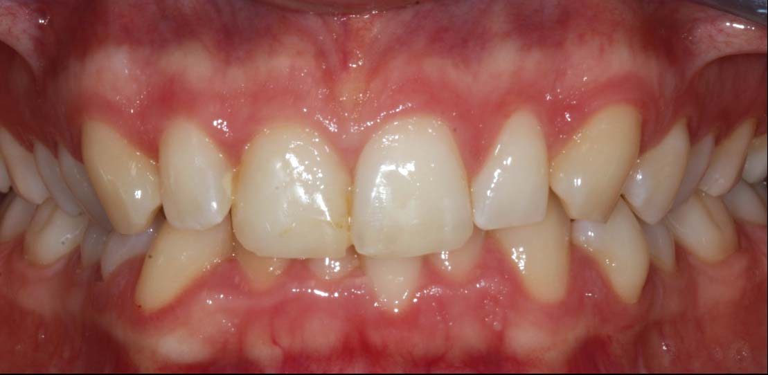 composite bonding - composite resin applied to natural teeth before