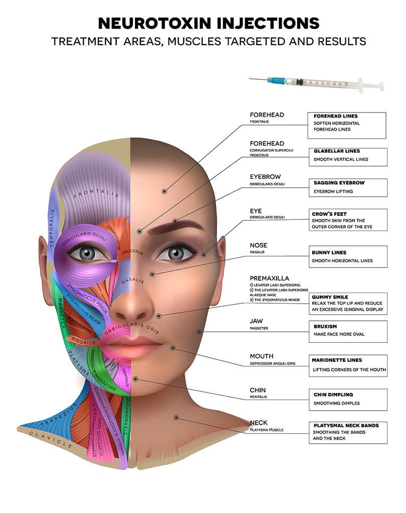 botox treatment areas