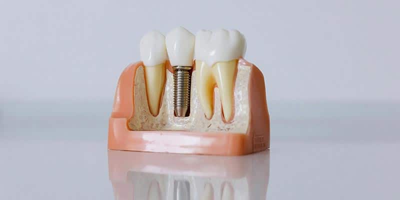 Dental Implant model